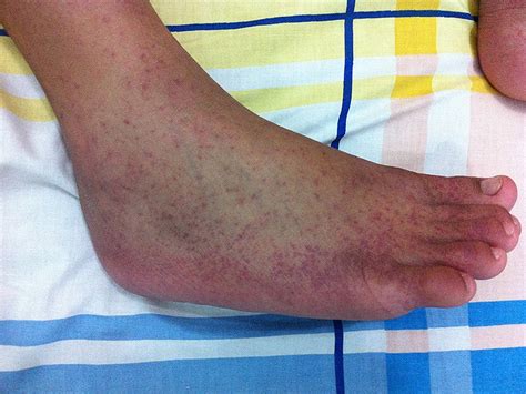 Leptospirosis Rash