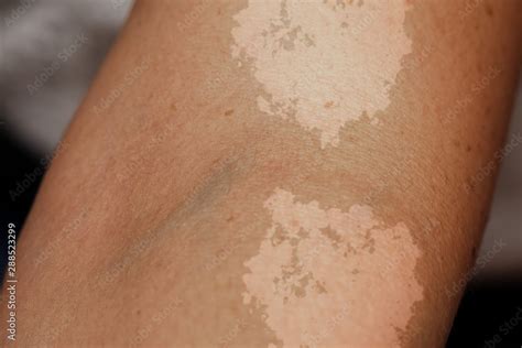 A closeup view on the arm of a person suffering from tinea versicolor ...