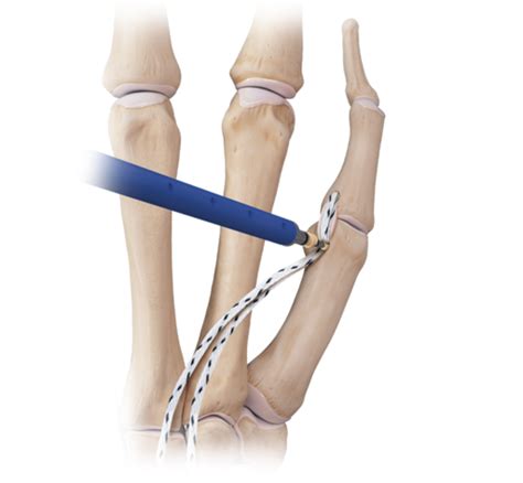 Ucl Ligament - Fpt Disorders Of The Elbow Ligaments Ucl Lucl ...