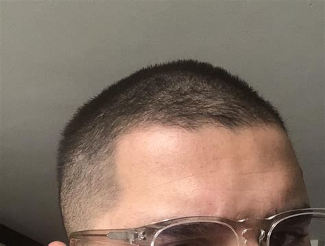 3 month Update minoxidil kirkland 5% foam : r/minoxidil