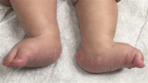 Treatment of rocker-bottom foot condition in newborns and children - Dr Ratnav Ratan