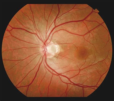 Optic Pits: case study, entity and management - Ophthalmology Education