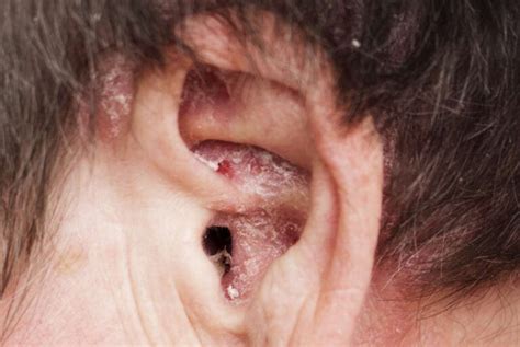 Managing Psoriasis Behind the Ear: Tips for Relief and Prevention - Flash Uganda Media