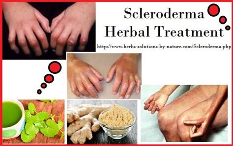 Five Homemade Scleroderma Herbal Treatments Body Tissues, Skin Disorders, Body Organs, Herbal ...