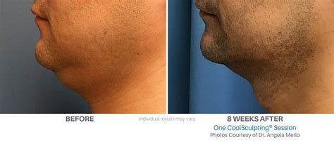 CoolSculpting before and after Images | Real Patient Results