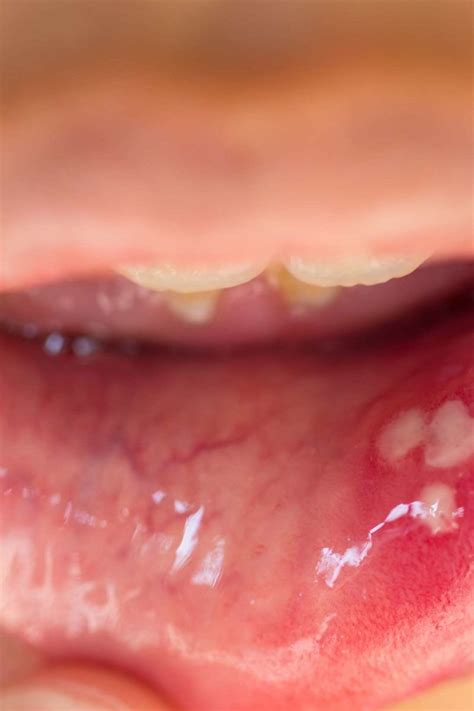 HPV in the mouth: Symptoms, causes, and treatment