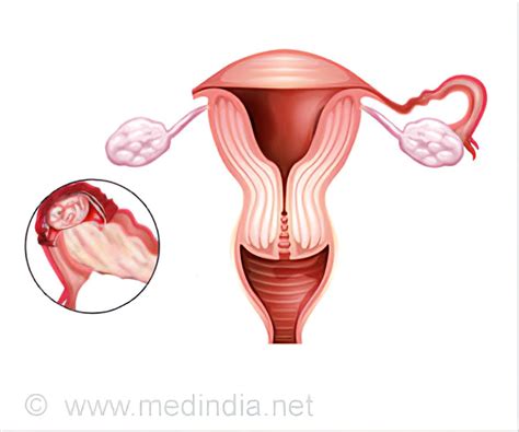 Salpingectomy - Types, Indications, Procedure, Complications