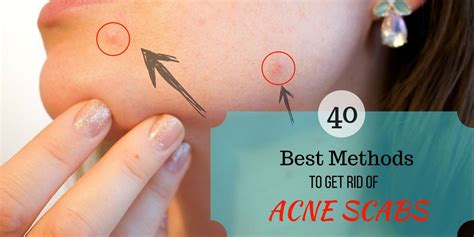 Get rid of acne scabs overnight fast by 40 best ways of DIY methods, Home remedies and ...