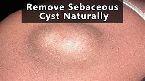 Remove Sebaceous Cyst Naturally at Home (Fast and Easy) | Home remedies for cysts, Home remedies ...