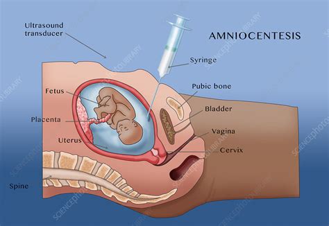 Amniocentesis, Illustration - Stock Image - C036/5445 - Science Photo Library