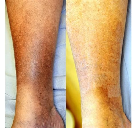 Hemosiderin Staining Legs Treatment