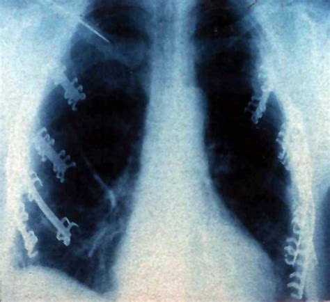 Surgical Stabilization of Severe Flail Chest | CTSNet