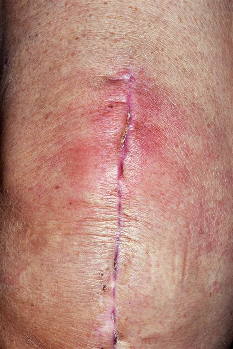 Infected Knee Replacement Surgery Wound Photograph by Dr P. Marazzi/science Photo Library