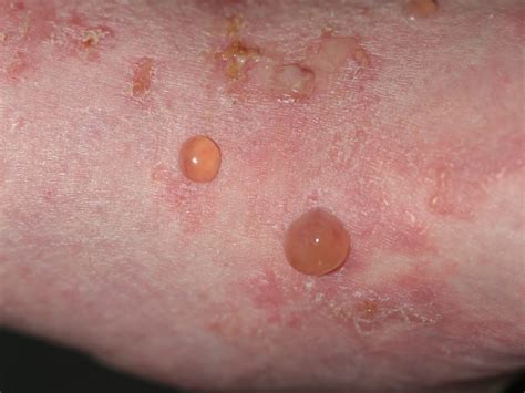 Bullous Pemphigoid - Causes, Symptoms, Treatment