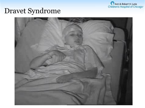 PPT - Dravet Syndrome: Diagnosis History Seizure Evolution PowerPoint Presentation - ID:4326876