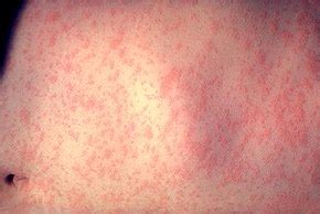 Mazelen - Measles - qaz.wiki
