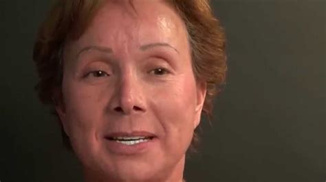 Patricia L | Golpa G4-Implant Solution Patient Testimonial - YouTube
