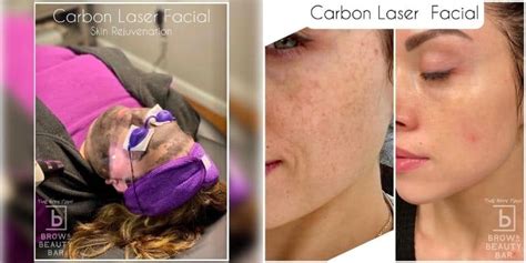 Carbon Laser Facial - Cost, Aftercare, Benefits | Brow & Beauty Bar