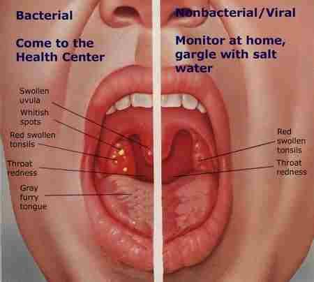 Sore Throat Gonorrhea Treatment Behind Bacterial Infection Tonsils ...