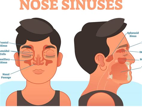 Saline Nasal Rinse For Sinus Infection Big Deals | hit.skku.edu