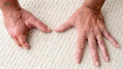 Dad's fingers lost in industrial blender accident, replaced with toes ...