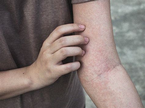 Non-blanching rash: Is it serious? Causes in adults and children