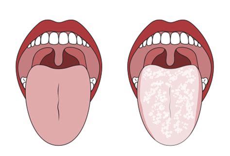 Treating an Oral Thrush Infection and Preventing Future Episodes | Convenient Urgent Care ...