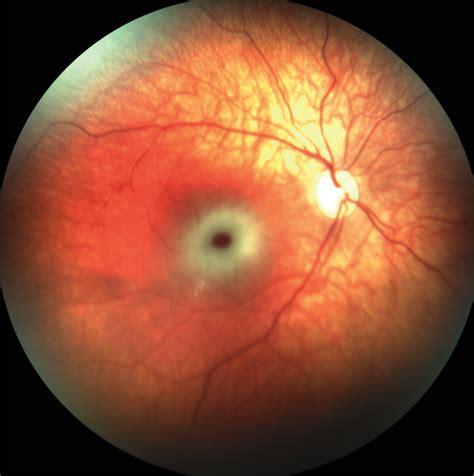 Cherry-Red Spot in Tay–Sachs Disease | NEJM