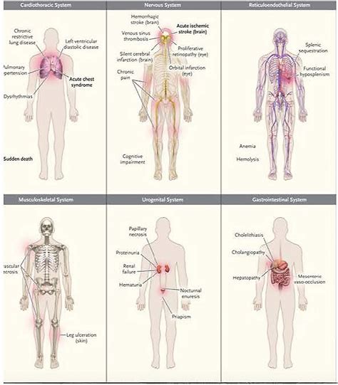 Frontiers | Life-Threatening Infectious Complications in Sickle Cell Disease: A Concise ...