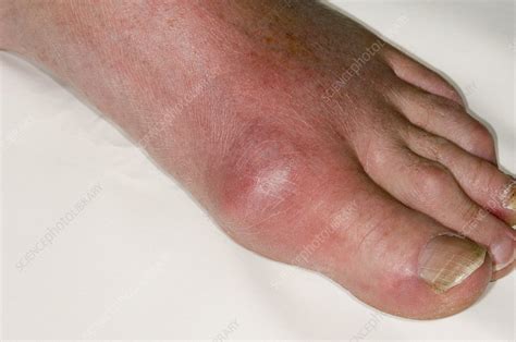 Gout of the big toe - Stock Image - C007/2724 - Science Photo Library