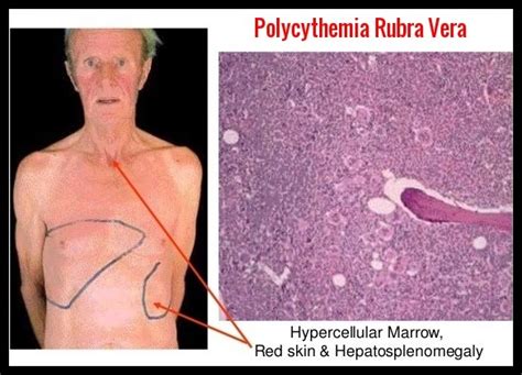 Polycythemia Rubra Vera - Ask Hematologist | Understand Hematology