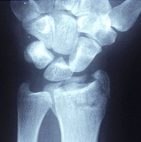 Broken Wrist (Distal Radius Fractures) Settlements from Accidents: Car ...