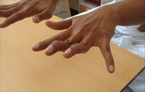 An Unusual Cause of Swan Neck Deformity of the Fingers | Trauma and ...