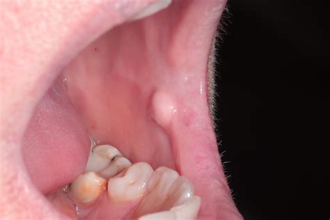 Pathology Outlines - Irritation fibroma