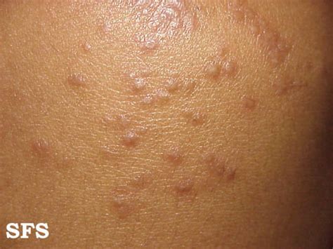 Scabies - wikidoc
