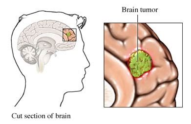 Are All Brain Tumors Cancerous? | Appledore Medical Group