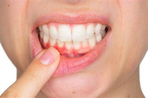 5 complications of dental avulsion that you should be aware of - One ...