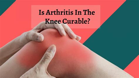 Knee Arthritis Severe Symptoms: Can You Treat Arthritis In Knee? Doctor ...