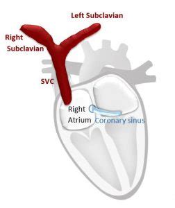 Persistent Left Superior Vena Cava (PLSVC): Anatomy and blood flow Cardioserv