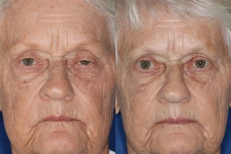 Before & After Photos | Eye Health Northwest