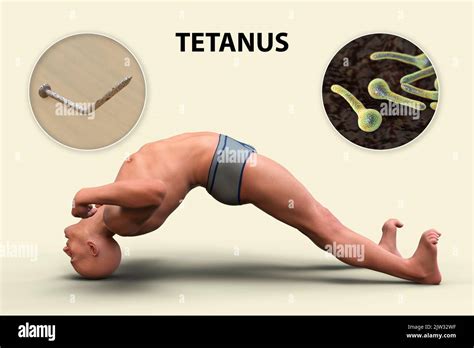 Mechanism of tetanus disease, illustration. A skin wound is contaminated with Clostridium tetani ...