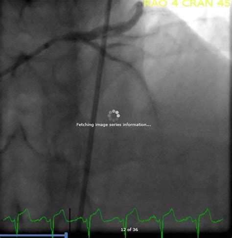 Dr. Smith's ECG Blog: See what happens when hyperacute T-waves are missed