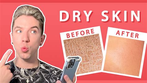 Your Dry Skin Questions ANSWERED - YouTube