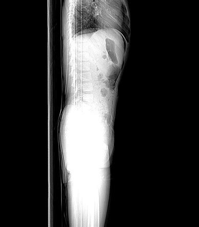 Cupola sign (pneumoperitoneum) | Radiology Reference Article | Radiopaedia.org