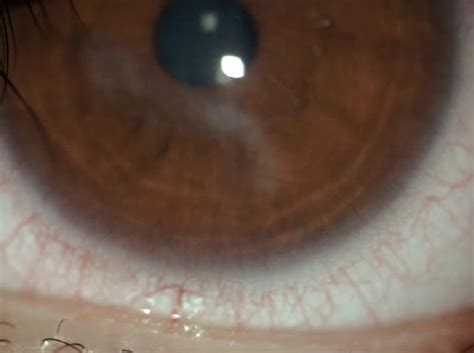 Phlyctenular Keratoconjunctivitis:a Teaching Case Report | The Journal of Optometric Education