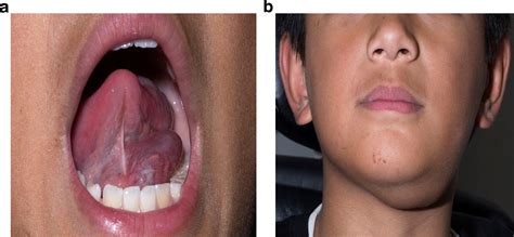 Sublingual gland - Operative Techniques in Otolaryngology-Head and Neck Surgery