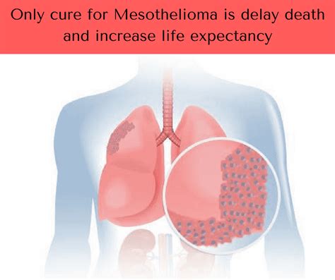 what-causes-mesothelioma-cancercure-for-mesothelioma-the-delay-deathand-increase-life-expectancey