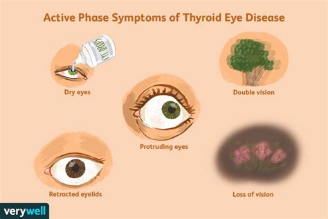 Progression and Prognosis in Thyroid Eye Disease