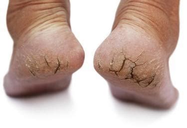 DRY CRACKED HEELS | Foot Medical Centre | Aurora Foot Specialist ...