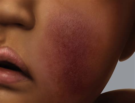 Eczema on dark skin | Eczema Foundation